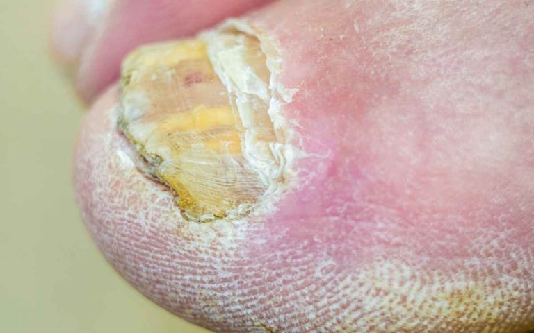 Fungal Toenail Home Remedies