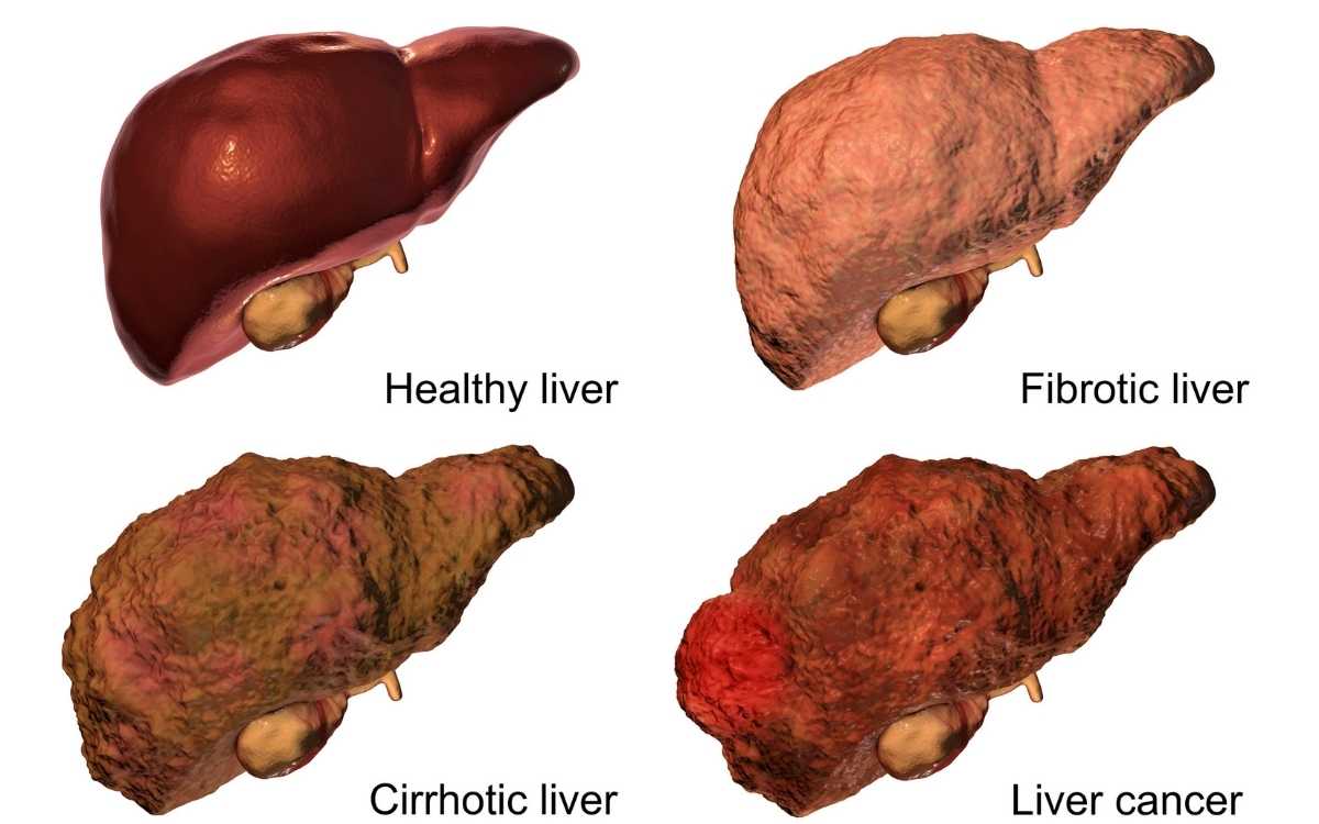 Symptoms of Liver Disease
