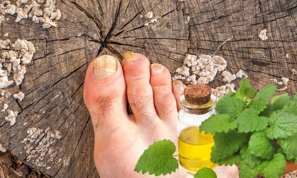 How To Treat Nail Fungus With Tea Tree Oil