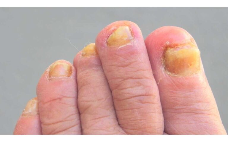 How To Prevent Toenail Fungus From Spreading To Family