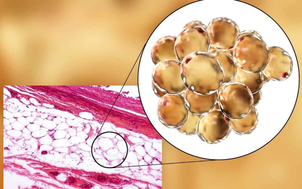 Is Low Brown Adipose Tissue The Root Causes Of Unexplained Weight Gain?