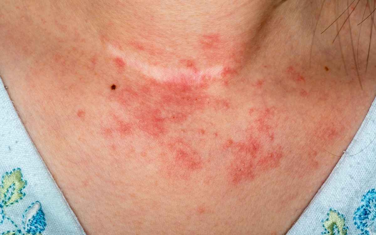 Home Doctor For Eczema