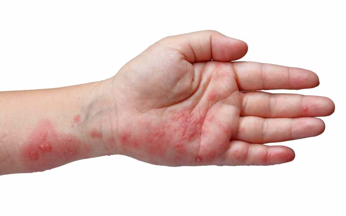 Home Doctor For Scabies