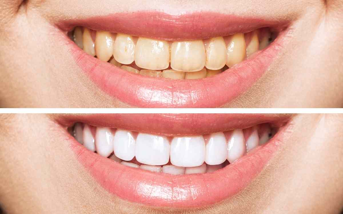 How Does LED Teeth Whitening Work?