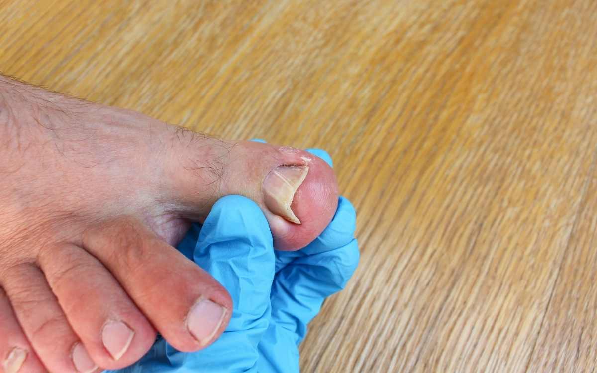 How to Remove an Ingrown Nail