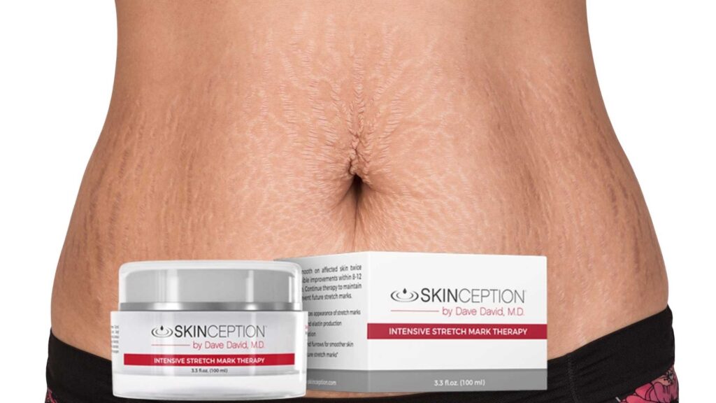 Skinception: Intensive Stretch Mark Therapy Review
