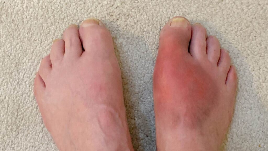 How Long Does A Gout Attack Last?
