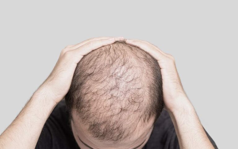 How To Prevent Balding Early