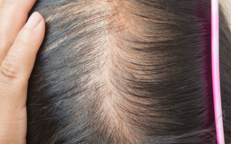 How To Stop Thinning Hair In Women