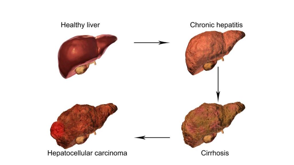 Fatty Liver Disease and Alcohol Consumption