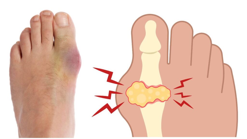 Treatment For Gout In The Big Toe