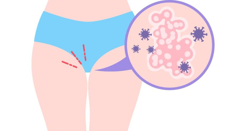 Yeast Infections In Senior Women