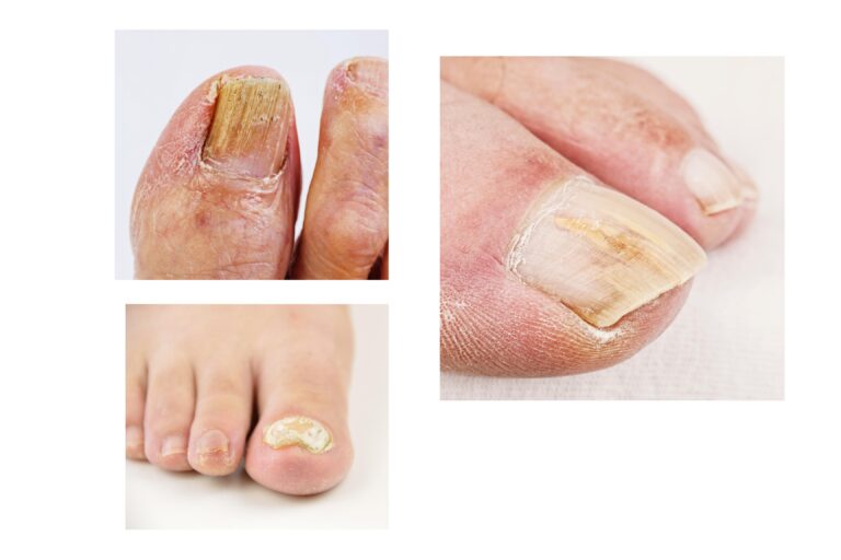 What Kills Nail Fungus Fast?