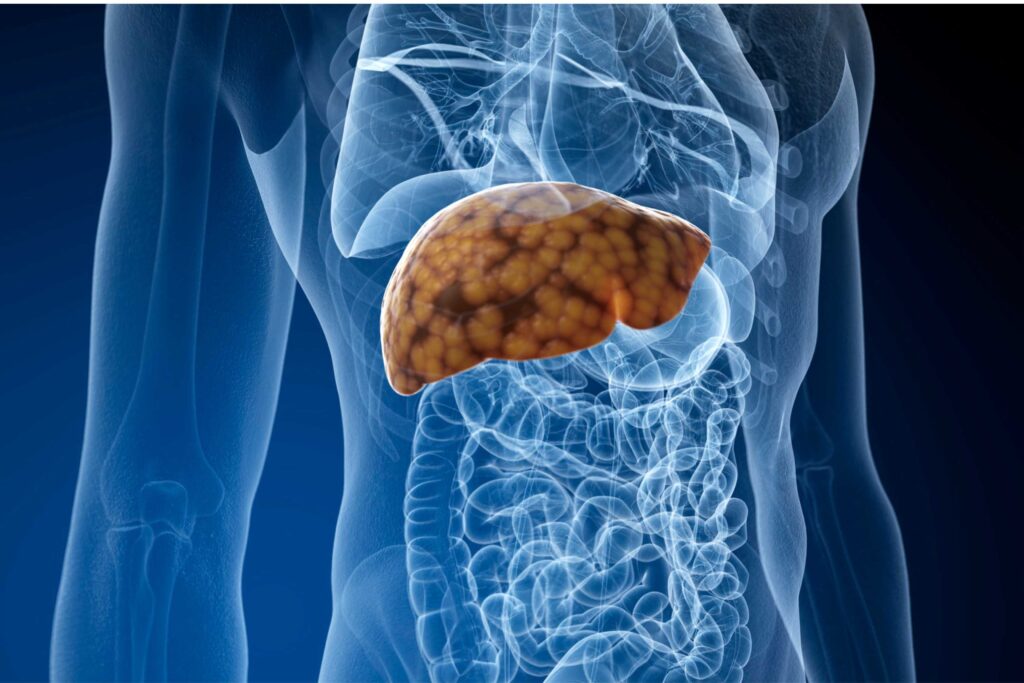 Can Fatty Liver Disease Be Reversed?
