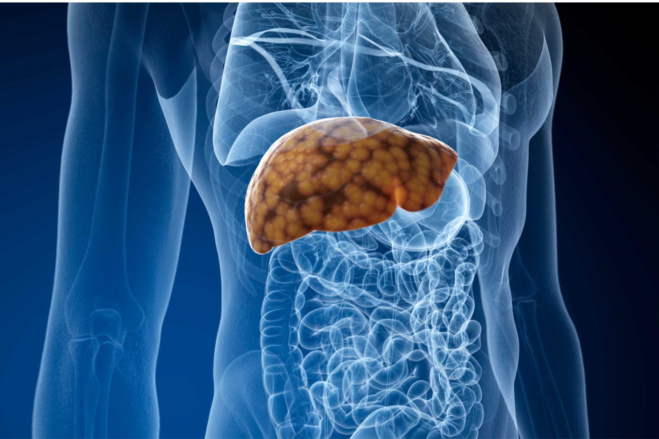 Can Fatty Liver Disease Be Reversed 