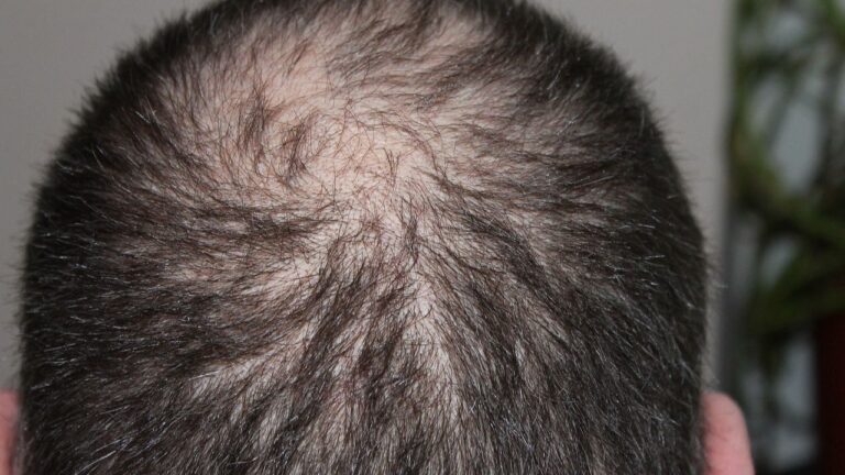 How High Blood Sugar Can Lead to Hair Loss