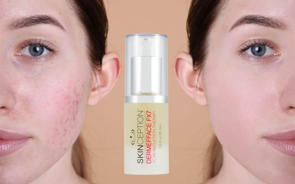 Dermaface Dermefface FX7 Review: Does It Really Reduce Scars?