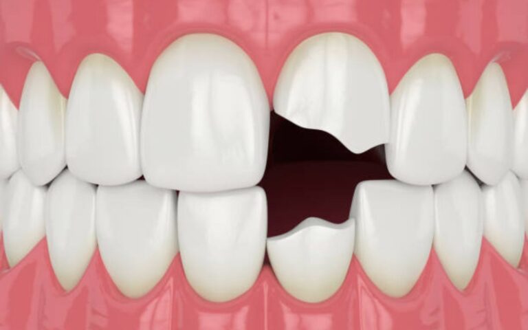 How to Fix a Chipped Tooth at Home Temporarily