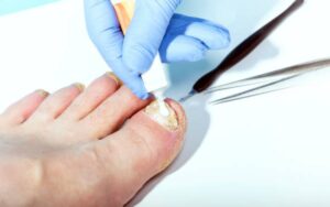 Best Toenail Fungus Treatment Over The Counter