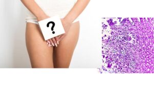 Do Yeast Infections Cure Themselves On Their Own?