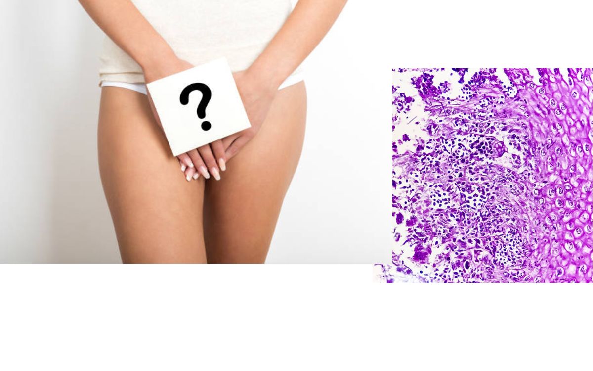 Do Yeast Infections Cure Themselves On Their Own?