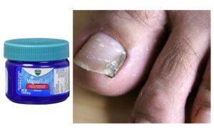 How To Use Vicks VapoRub For Toenail Fungus?