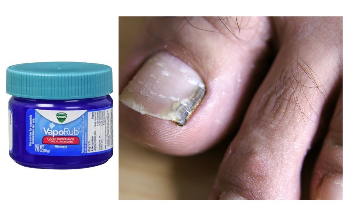 How To Use Vicks VapoRub For Toenail Fungus?
