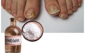 Nail Fungus Home Remedies Vinegar