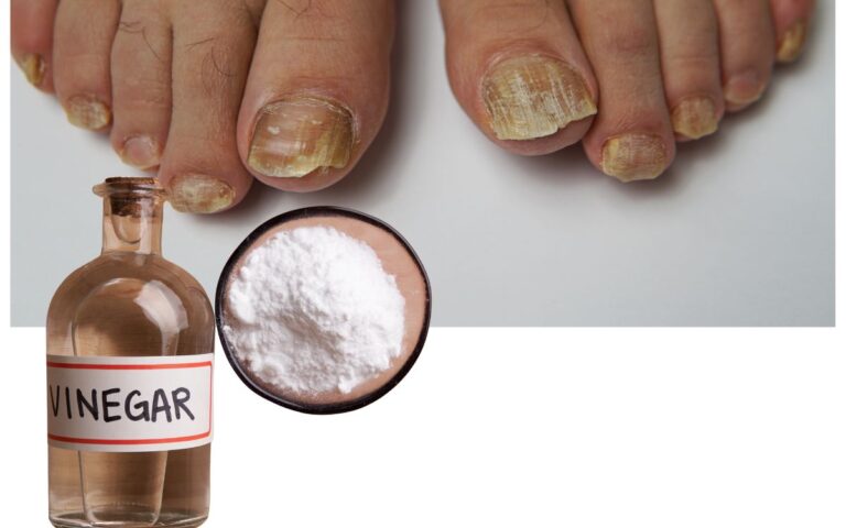 Nail Fungus Home Remedies Vinegar