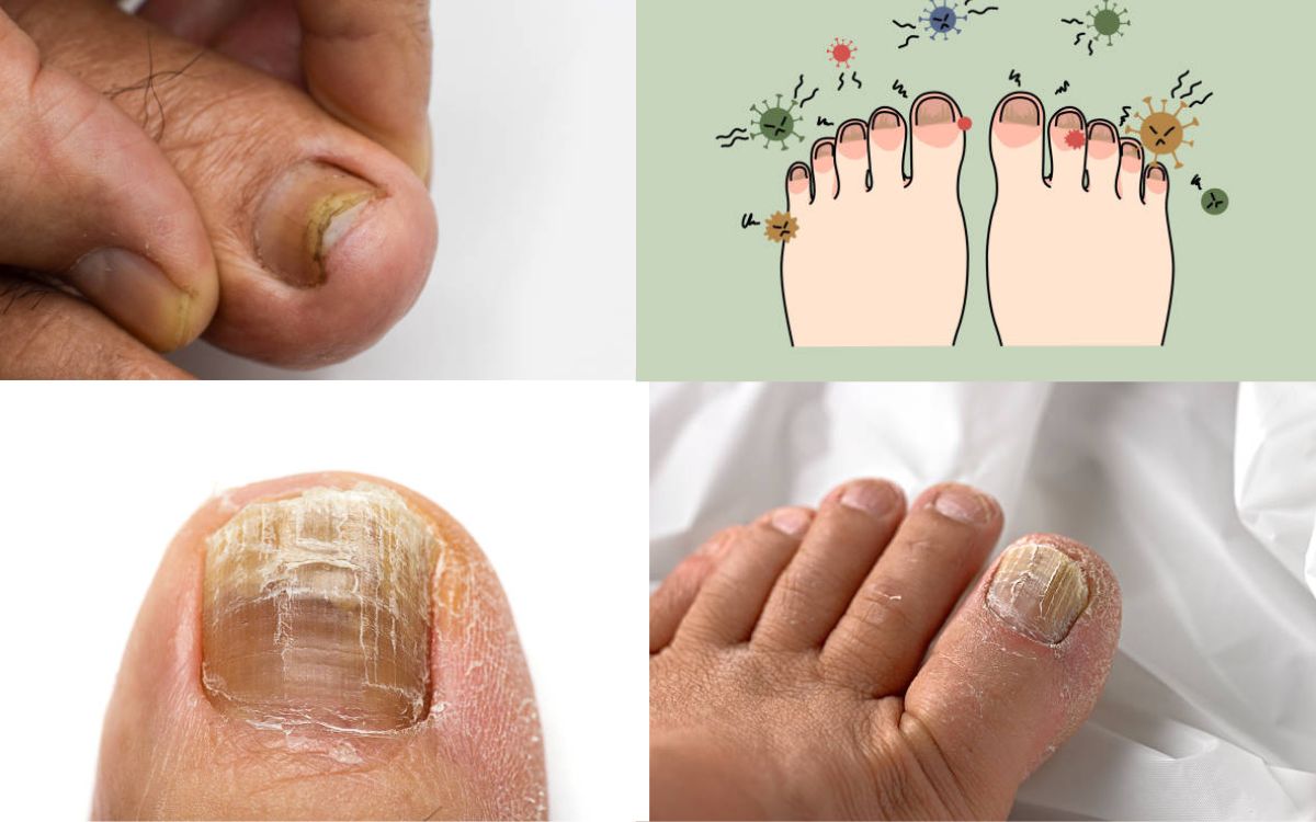 Overnight Toenail Fungus Cure