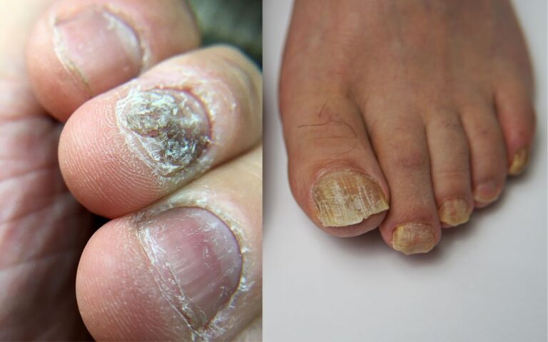 What Kills Fingernail Fungus Instantly