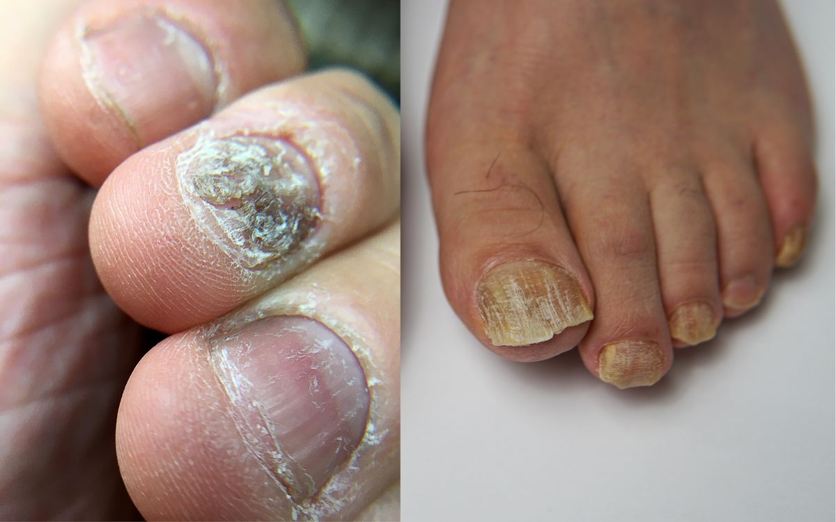 What Kills Fingernail Fungus Instantly